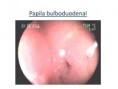 /album/ubicacion-aberrante-de-papila/asenda-papila-bulboduodenal-1-4-jpg/